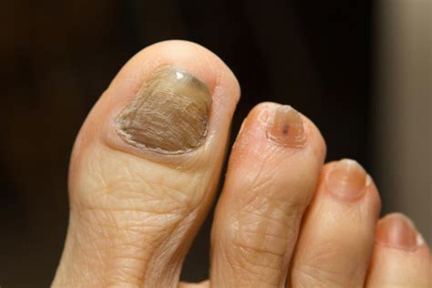 Che cosa causa un accumulo di cheratina sotto i toenails?